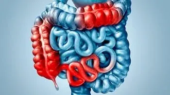 Oxford identifica autoanticuerpos anti-IL-10 en 3,5% de pacientes con EII