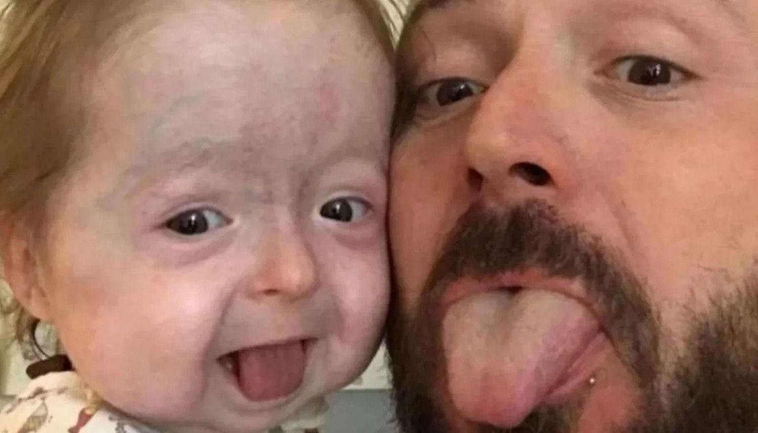 Una nena tiene dos años pero parece de 80 por la enfermedad de “Benjamin Button”