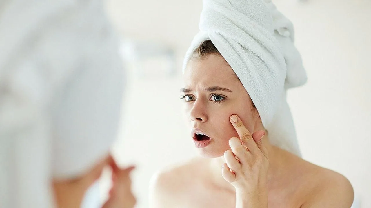 Tratamiento del acné: una guía dermatológica para prevenir secuelas